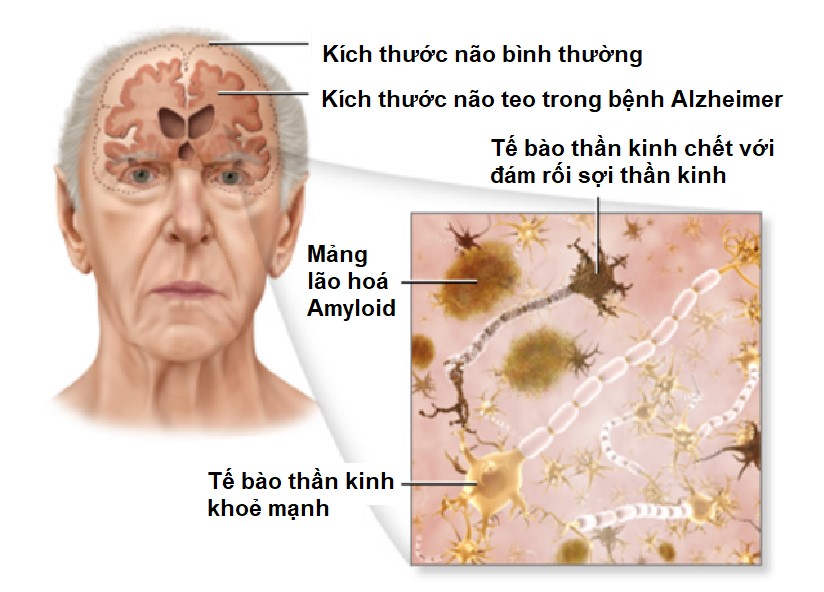 Cơ chế hình thành bệnh Alzheimer: Mảng amyloid β tích tụ ngoài tế bào thần kinh và đám rối sợi tau bên trong khiến tế bào não chết dần, dẫn đến não teo và mất trí nhớ nặng.