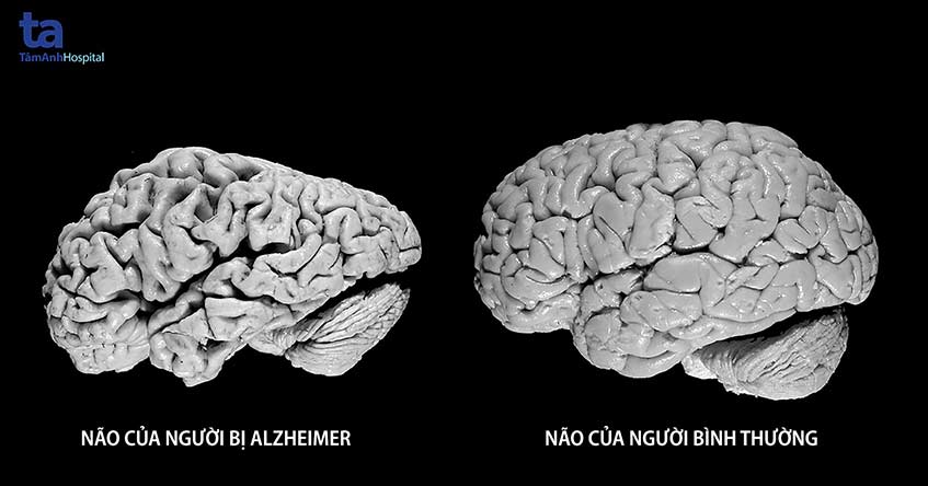 Não người bị Alzheimer (trái) teo nhỏ rõ rệt so với não người bình thường (phải). Teo não là đặc trưng điển hình của bệnh Alzheimer, đặc biệt ở vùng hồi hải mã – nơi chịu trách nhiệm về trí nhớ.
